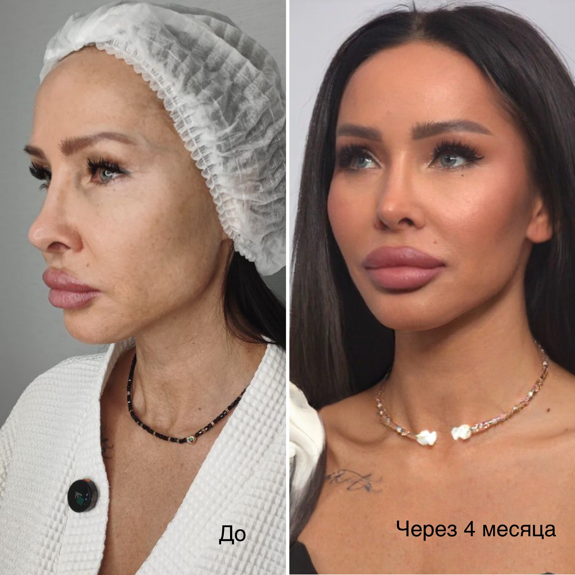 Реконструктивная костная пластика