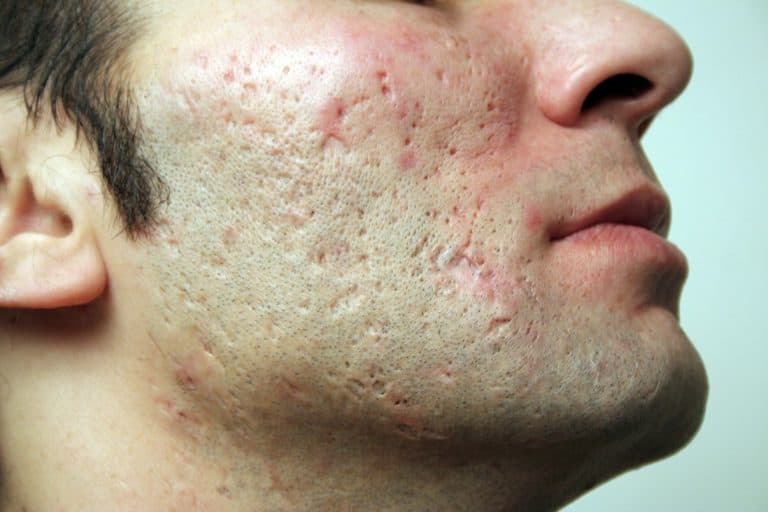 Атрофические рубцы на лице – причины образования и основные методы лечения