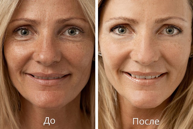 Разновидности лазерного пилинга для лица от морщин и прочих проблем кожи