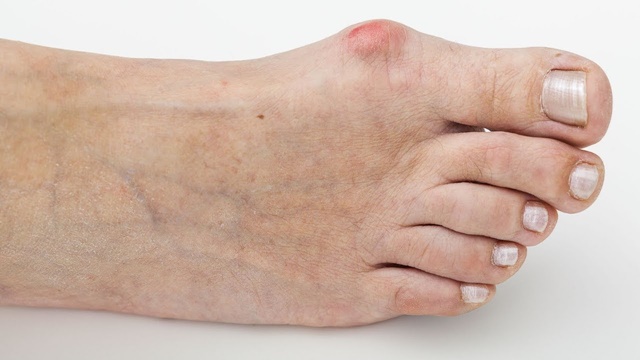 5 способов избавиться от косточки на большом пальце ноги самостоятельно