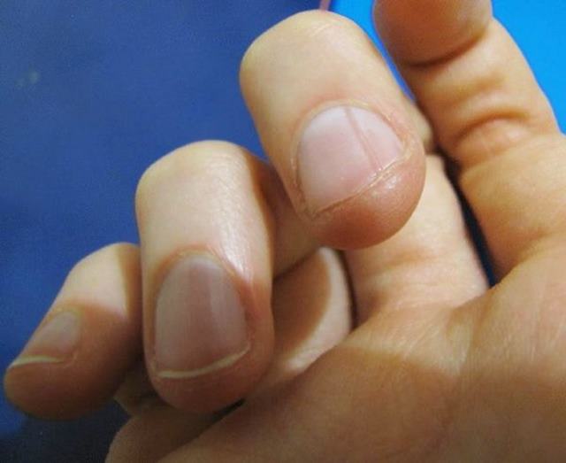 Как обследовать травму ногтевой пластины