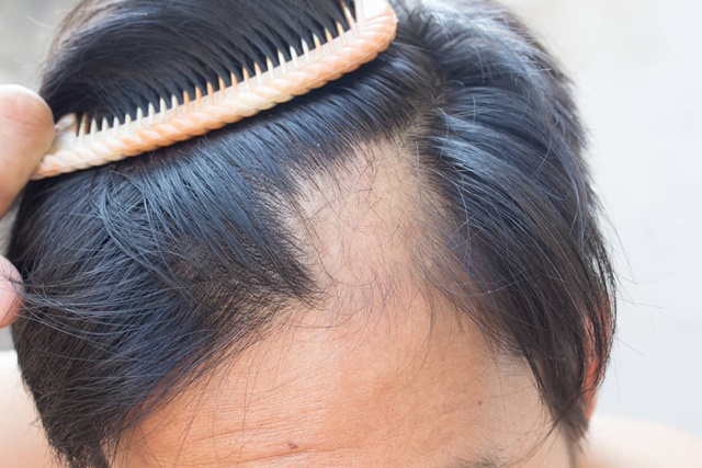 Профилактические меры, которые помогут избежать выпадения волос