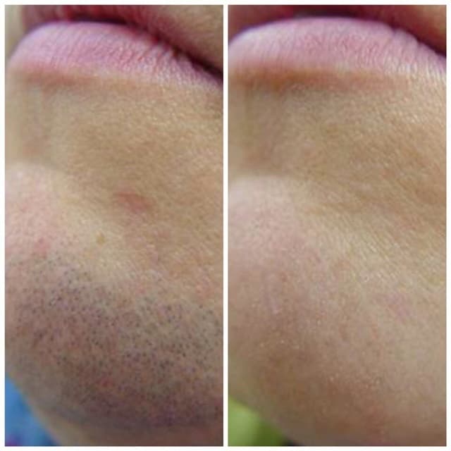 Уход за кожей лица до и после процедуры эпиляции