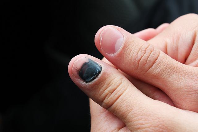 Причины травмирования ногтевой пластины