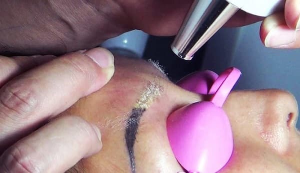 Подготовка к удалению татуажа бровей лазером